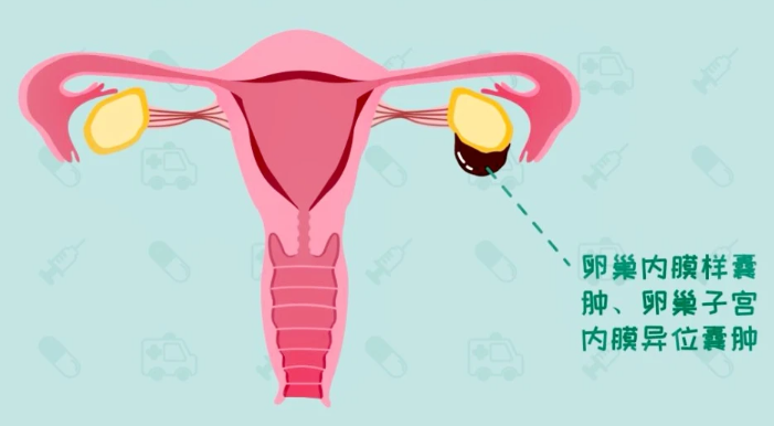 卵巢巧克力囊肿的危害是什么？卵巢巧克力囊肿的治疗办法？卵巢巧克力囊肿可以做试管婴儿吗？