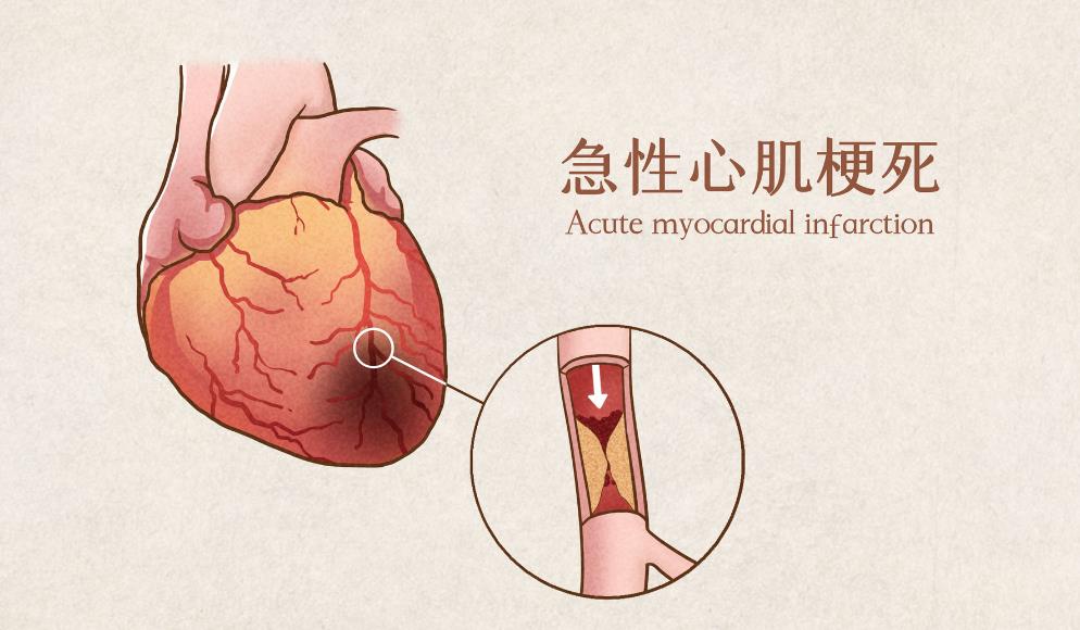 ami医学上是什么意思,ami的含义