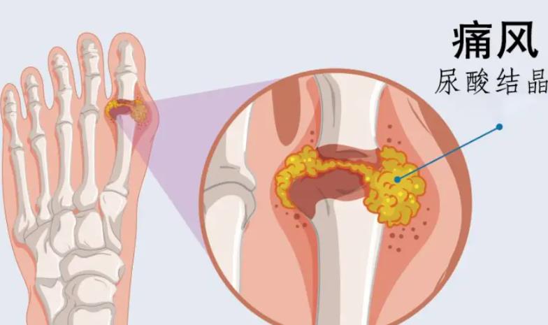 什么是痛风,为什么痛风的人活不长