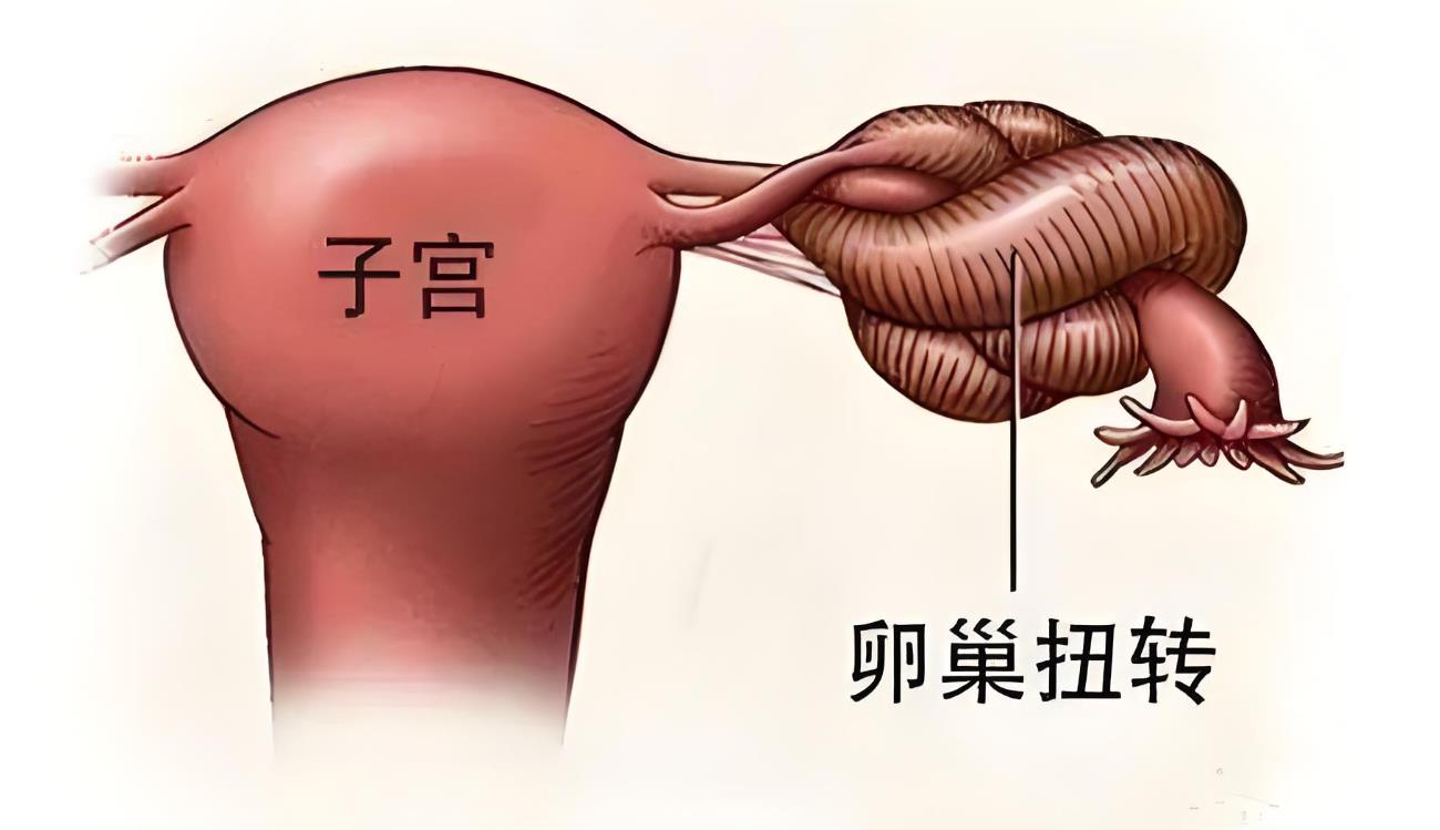 卵巢蒂扭转b超看得出吗