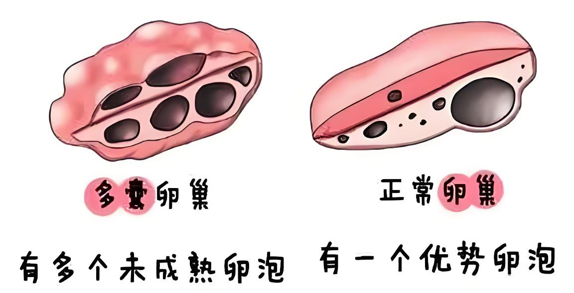 做b超可以检查出多囊卵巢吗