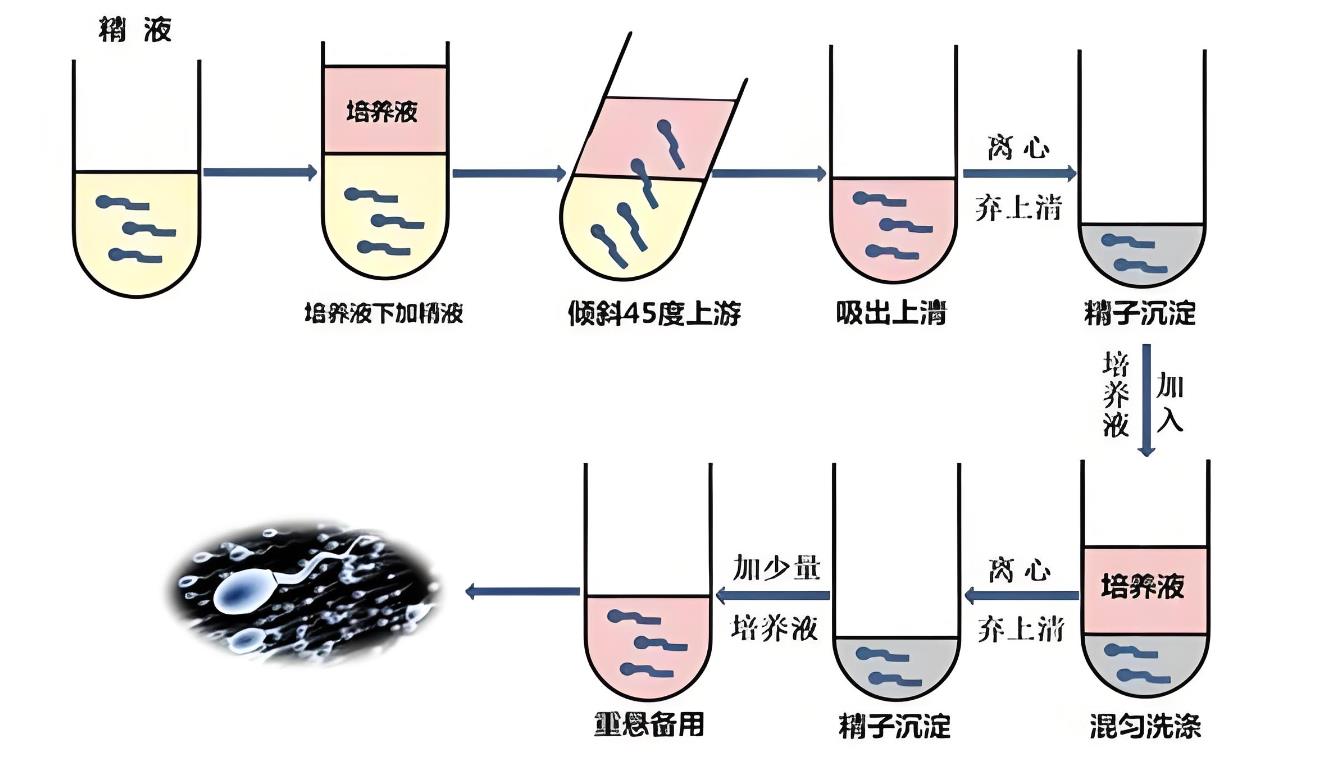 Y精子分离术:技术、应用及误区